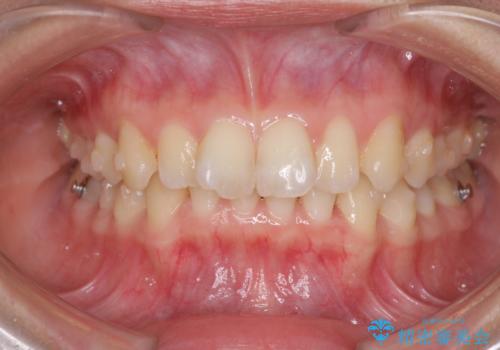 インビザラインによる前歯の矯正治療の治療中