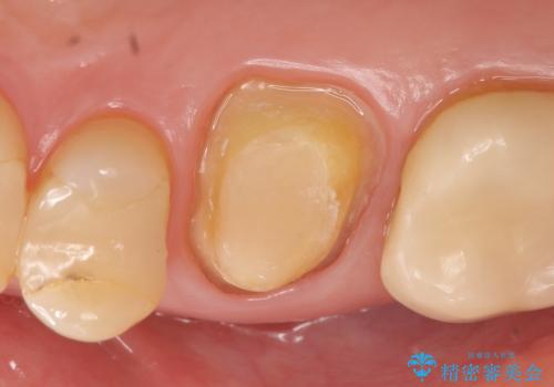 オールセラミッククラウン 根管治療後の補綴の治療中
