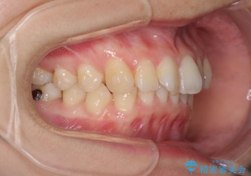 インビザラインによる前歯の矯正治療の治療中