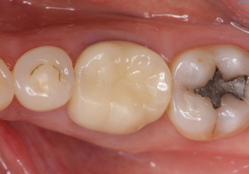 オールセラミッククラウン 根管治療後の補綴の治療後