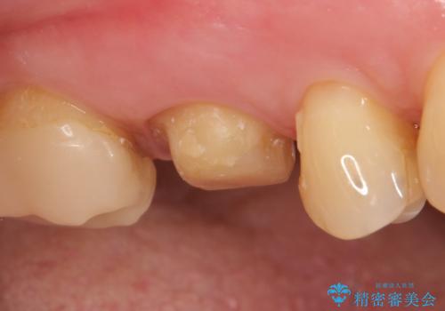 オールセラミッククラウン 根管治療後の補綴の治療中