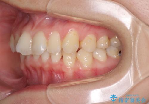 インビザラインによる前歯の矯正治療の治療中