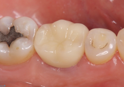 オールセラミッククラウン 根管治療後の補綴の治療後