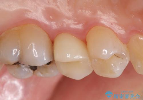 オールセラミッククラウン しみる歯の治療の治療後