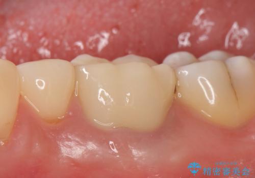 オールセラミッククラウン 根管治療後の補綴の治療後