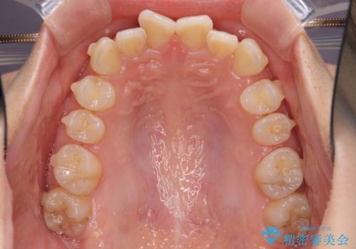 インビザラインによる前歯の矯正治療の治療中