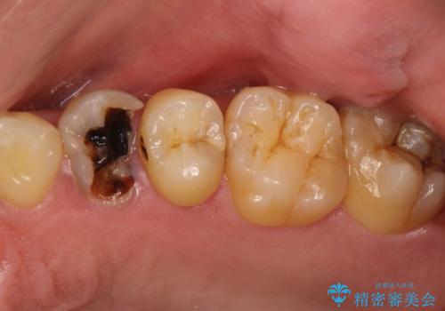 大きな虫歯で崩壊した歯の修復の症例 治療前