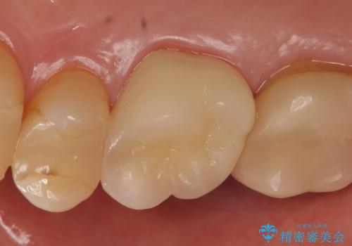 オールセラミッククラウン 根管治療後の補綴の治療後