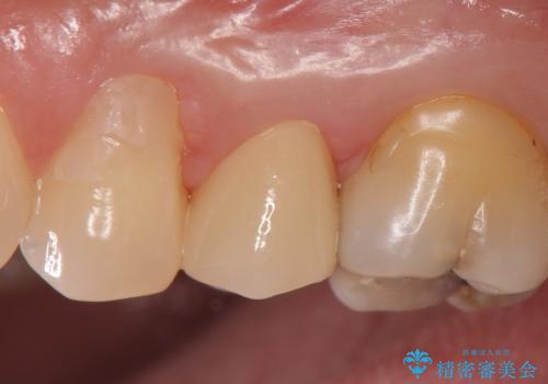オールセラミッククラウン しみる歯の治療の治療後
