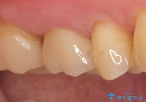 オールセラミッククラウン 根管治療後の補綴の治療後