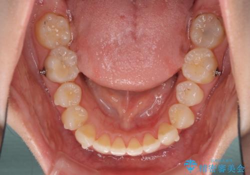 インビザラインによる前歯の矯正治療の治療中