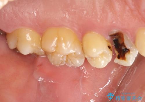 大きな虫歯で崩壊した歯の修復の治療前