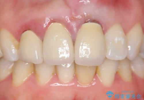 オールセラミッククラウン(スペシャル) 不揃いな前歯を美しくの治療前