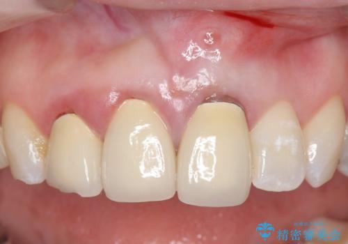 オールセラミッククラウン(スペシャル) 不揃いな前歯を美しくの症例 治療前