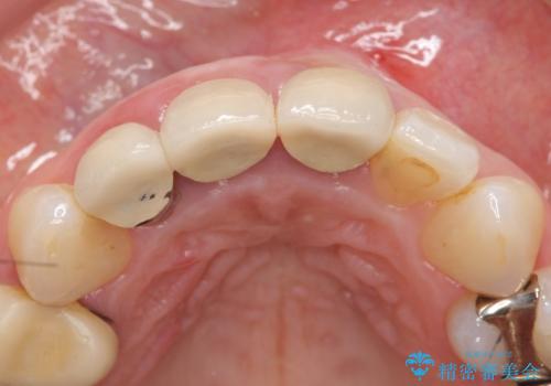 オールセラミッククラウン(スペシャル) 不揃いな前歯を美しくの治療前