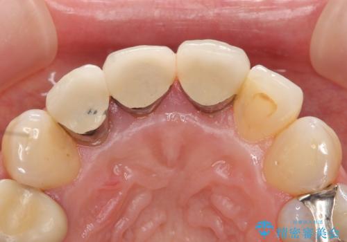 オールセラミッククラウン(スペシャル) 不揃いな前歯を美しくの治療前