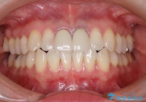 前歯の根元が黒い　オールセラミッククラウンの装着による改善の治療前