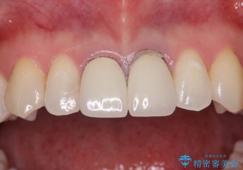 前歯の根元が黒い オールセラミッククラウンの装着による改善