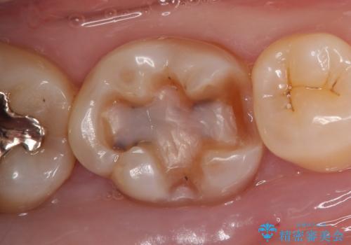 セラミックインレー 虫歯治療の治療中