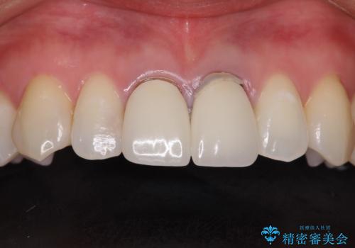 前歯の根元が黒い オールセラミッククラウンの装着による改善の治療前