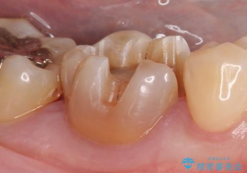 セラミックインレー 虫歯治療の治療中