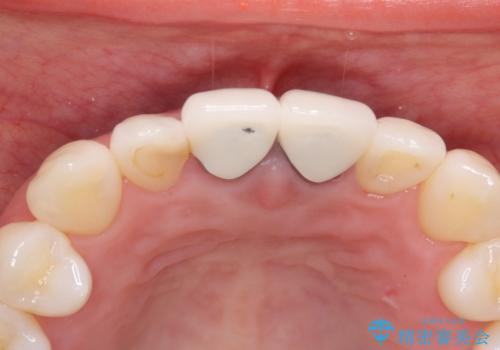 前歯の根元が黒い オールセラミッククラウンの装着による改善の治療前