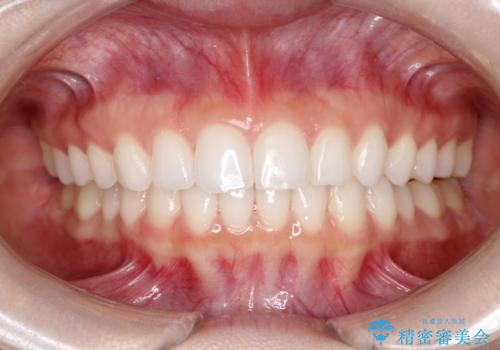 出っ歯の矯正治療 歯を抜かずにインビザラインでの治療後