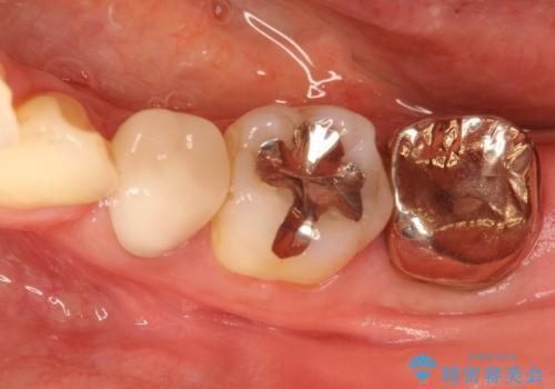 奥歯が痛い。根管治療からセラミッククラウンの治療前