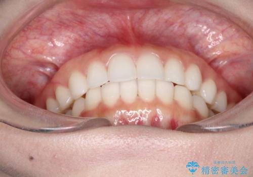 出っ歯の矯正治療　歯を抜かずにインビザラインでの治療後