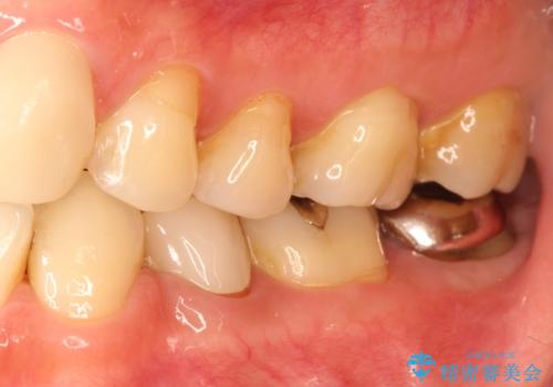 奥歯が痛い。根管治療からセラミッククラウンの治療前