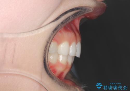 出っ歯の矯正治療 歯を抜かずにインビザラインでの治療後