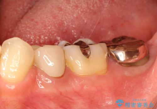 奥歯が痛い。根管治療からセラミッククラウンの治療前