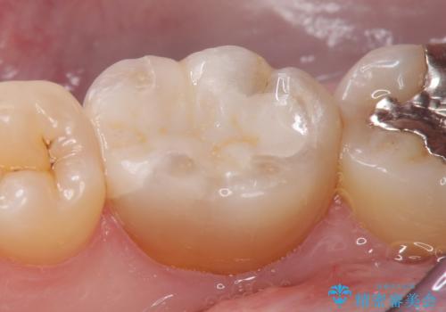 セラミックインレー 虫歯治療の治療後