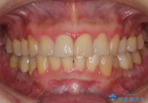 昔ぶつけた前歯 つめもの変色の治療後