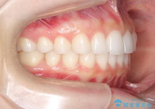 出っ歯の矯正治療　歯を抜かずにインビザラインでの症例 治療後
