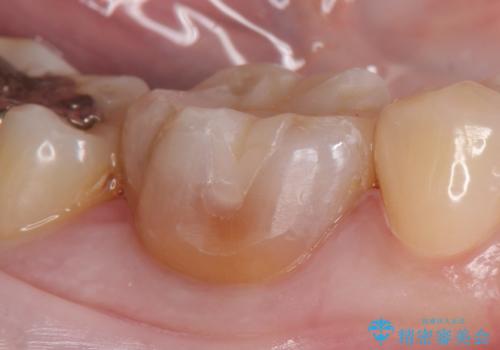 セラミックインレー 虫歯治療の治療後