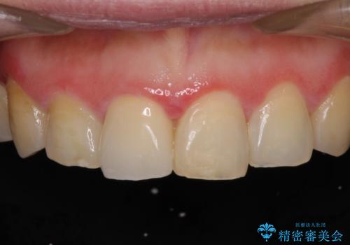 昔ぶつけた前歯 つめもの変色の治療後