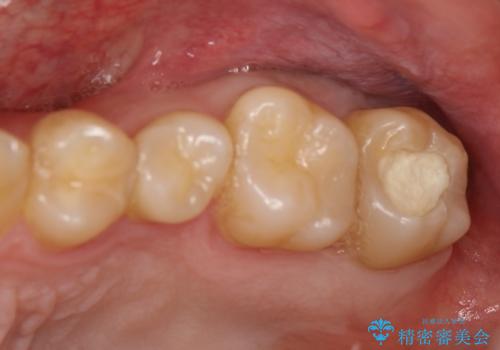 奥歯が痛い!　中途半端な治療をしっかりとやり治すの症例 治療前