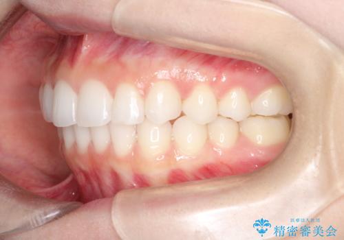 出っ歯の矯正治療　歯を抜かずにインビザラインでの治療後
