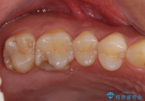 米国で笑われた 保険のつめものをやり直すの治療前