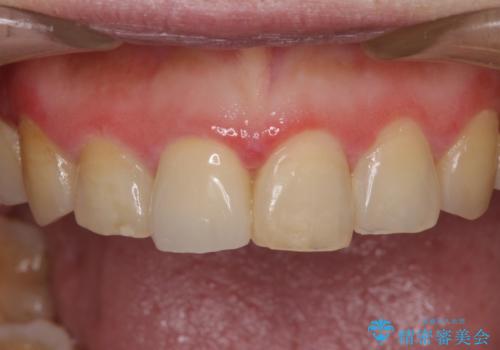 昔ぶつけた前歯 つめもの変色の症例 治療後