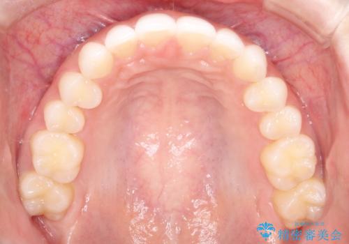 出っ歯の矯正治療 歯を抜かずにインビザラインでの治療後