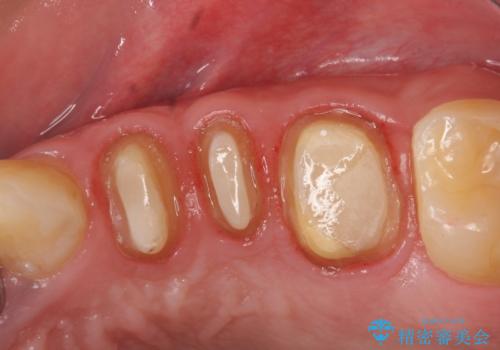 オールセラミッククラウン 根管治療・深い虫歯の治療の治療中