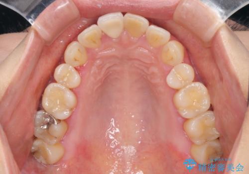 昔ぶつけた前歯 つめもの変色の治療後