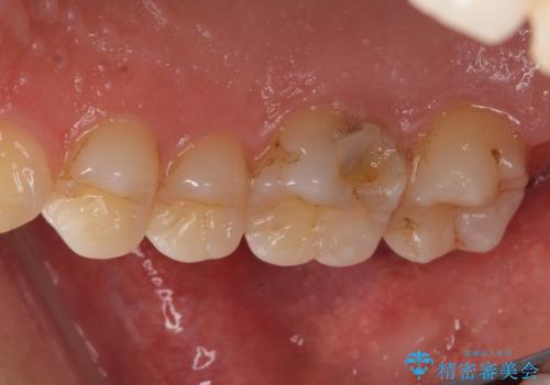 米国で笑われた 保険のつめものをやり直すの症例 治療前