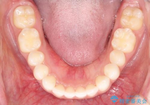 出っ歯の矯正治療 歯を抜かずにインビザラインでの治療中
