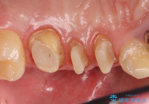 オールセラミッククラウン 根管治療・深い虫歯の治療の治療中