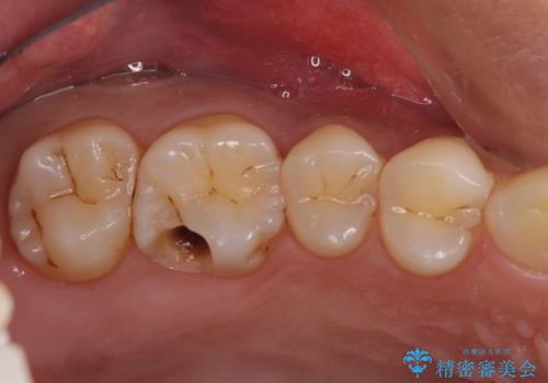 米国で笑われた 保険のつめものをやり直すの治療中