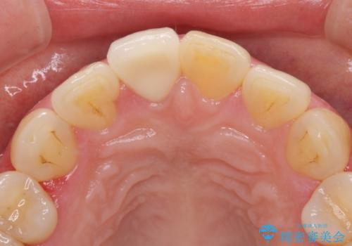 昔ぶつけた前歯 つめもの変色の治療後