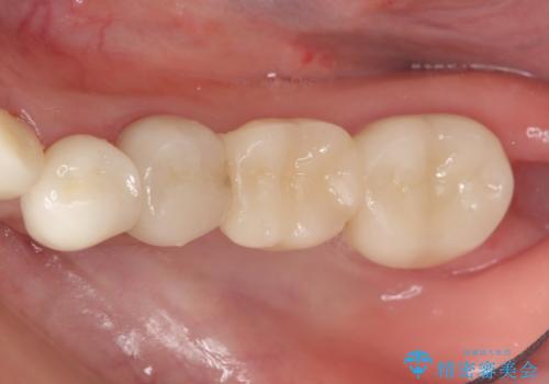 オールセラミッククラウン　銀歯を白い歯への症例 治療後